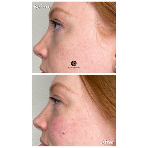 Let Me FILL You In On Cosmetic Fillers